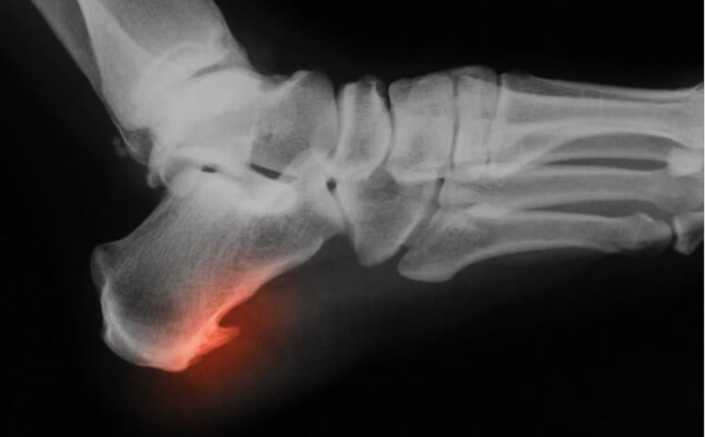 BONE SPURS FROM PLANTAR FASCIITIS - physiodelivered